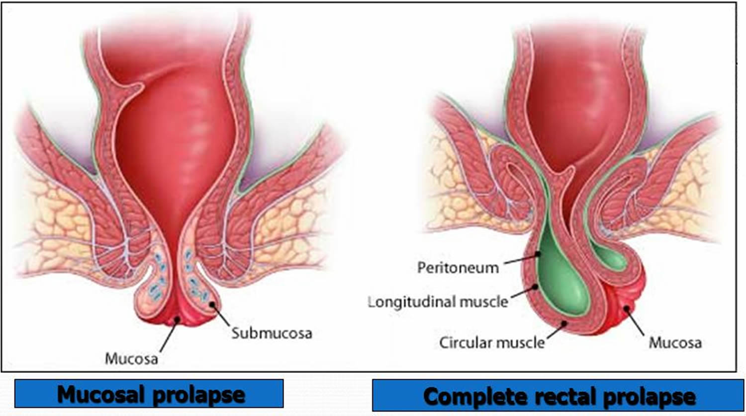 Causes of rectal prolapse and symptoms of rectal prolapse. How to differentiate between a rectal prolapse vs hemorrhoids. Current surgery treatment