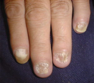 Fingernails - Ingrown fingernails - Dark Line - Fingernail Pain