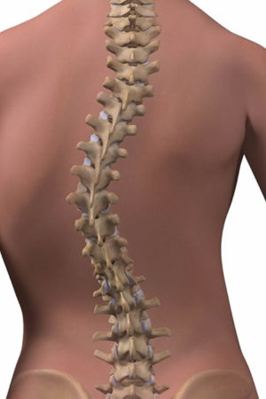 scoliosis
