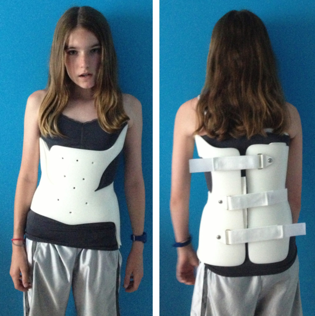 Scoliosis - Adults & Children - Causes, Treatment, Brace, Exercise