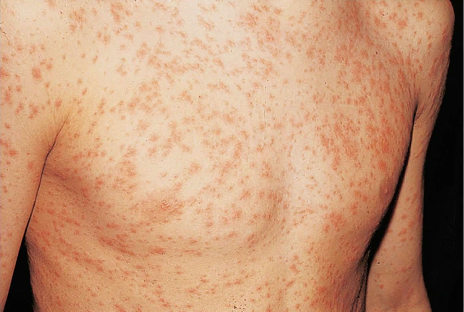 heat-rash-pictures-symptoms-causes-types-and-treatment