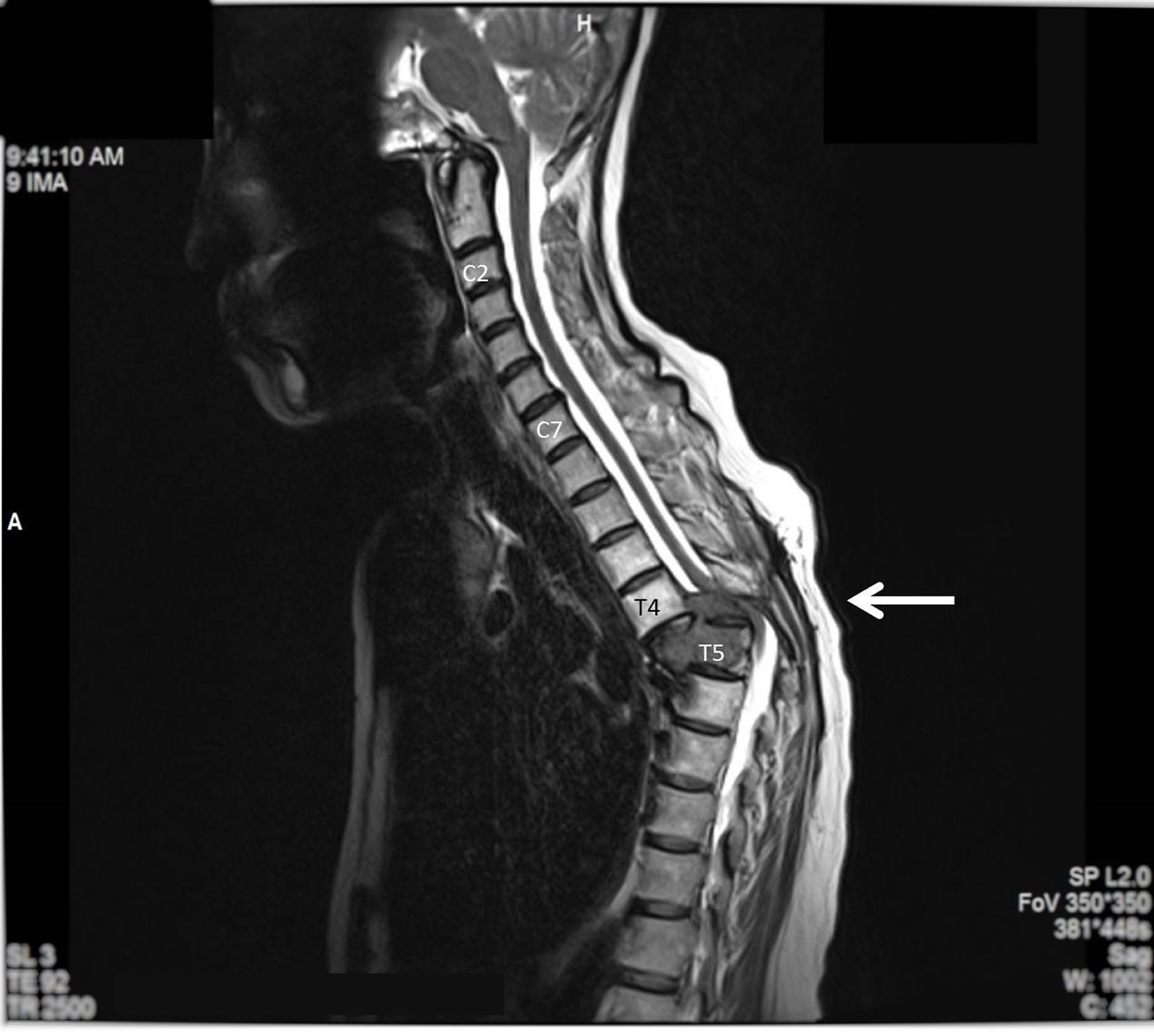 compressed spine treatment