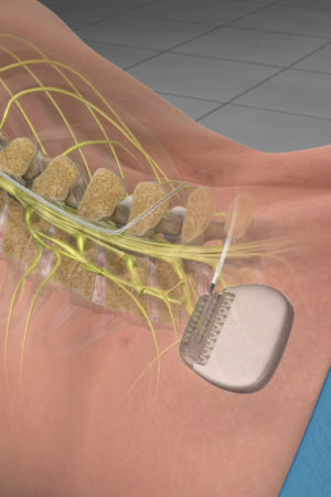 spinal cord stimulator