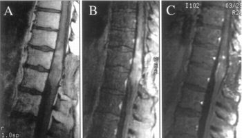spinal cord tumor