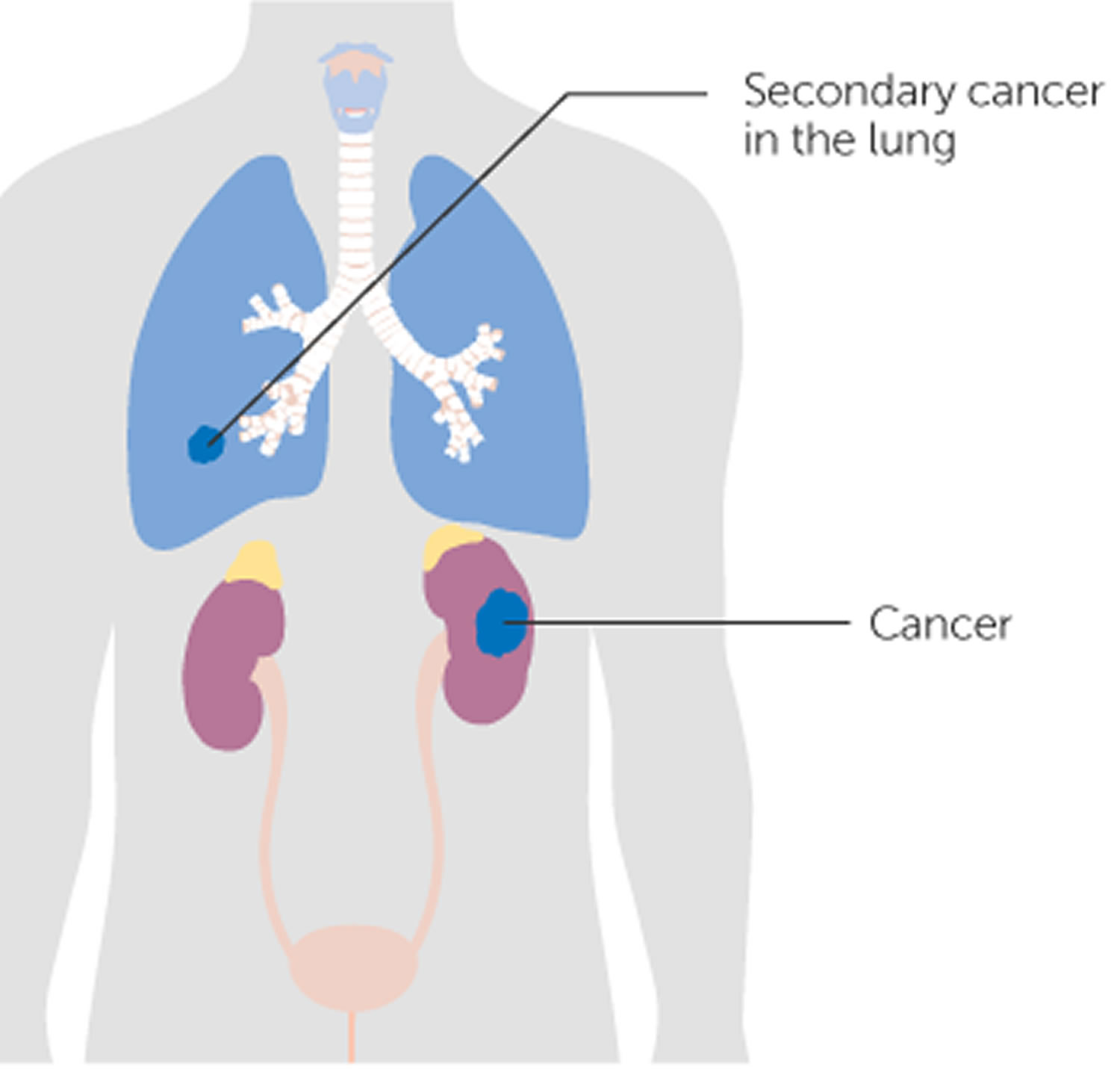 stage 4 kidney cancer