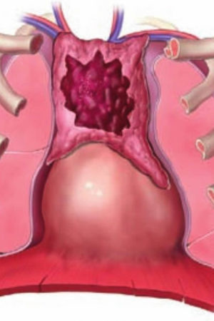 thymus cancer