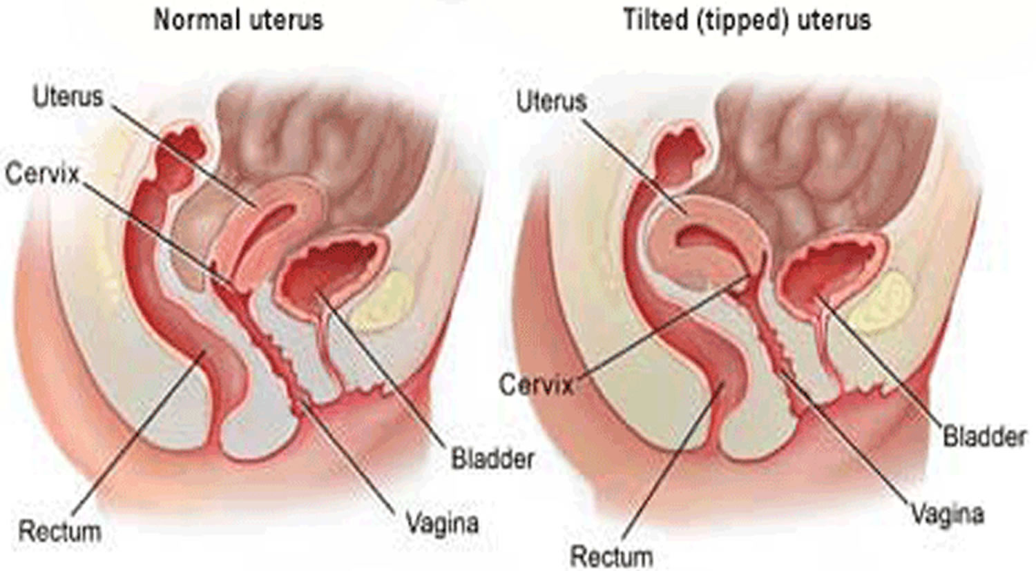 Tilted Uterus Causes Symptoms Diagnosis Treatment And Pregnancy 