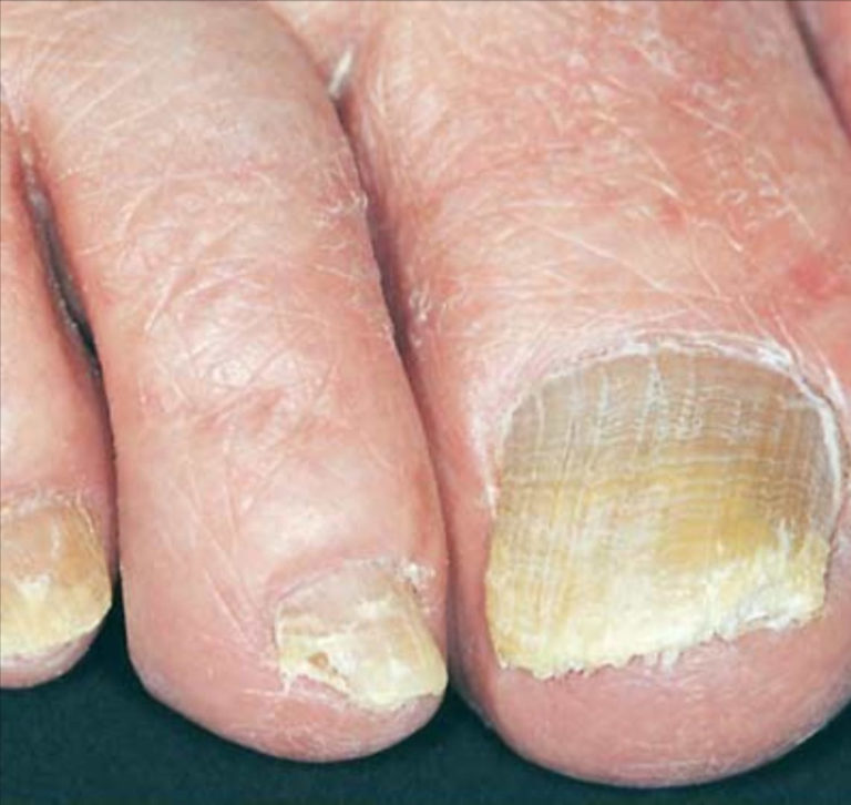 Toenail Fungus - Medication & Treatment - Home Remedies