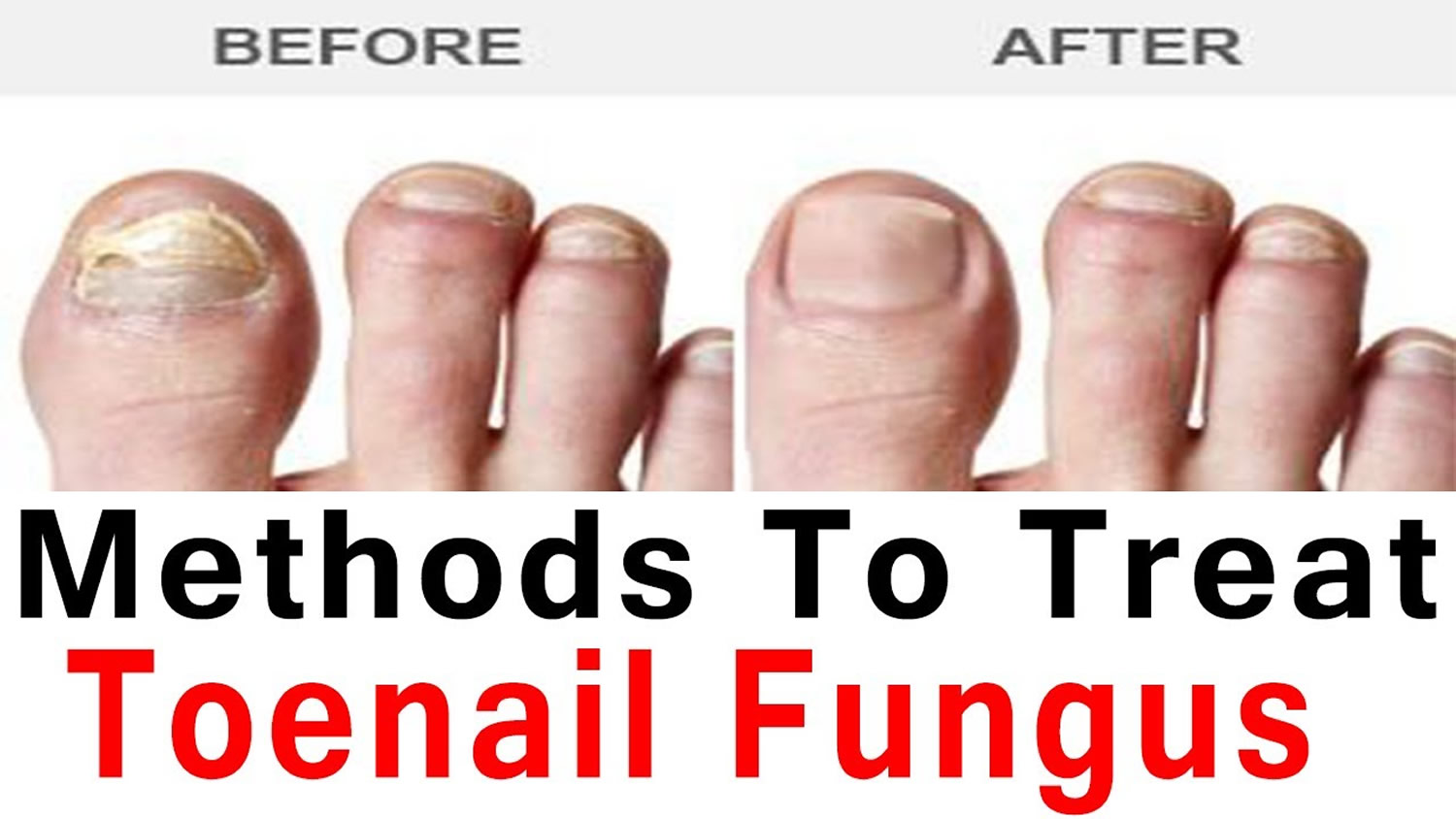 Toenail Fungus - Medication & Treatment - Home Remedies