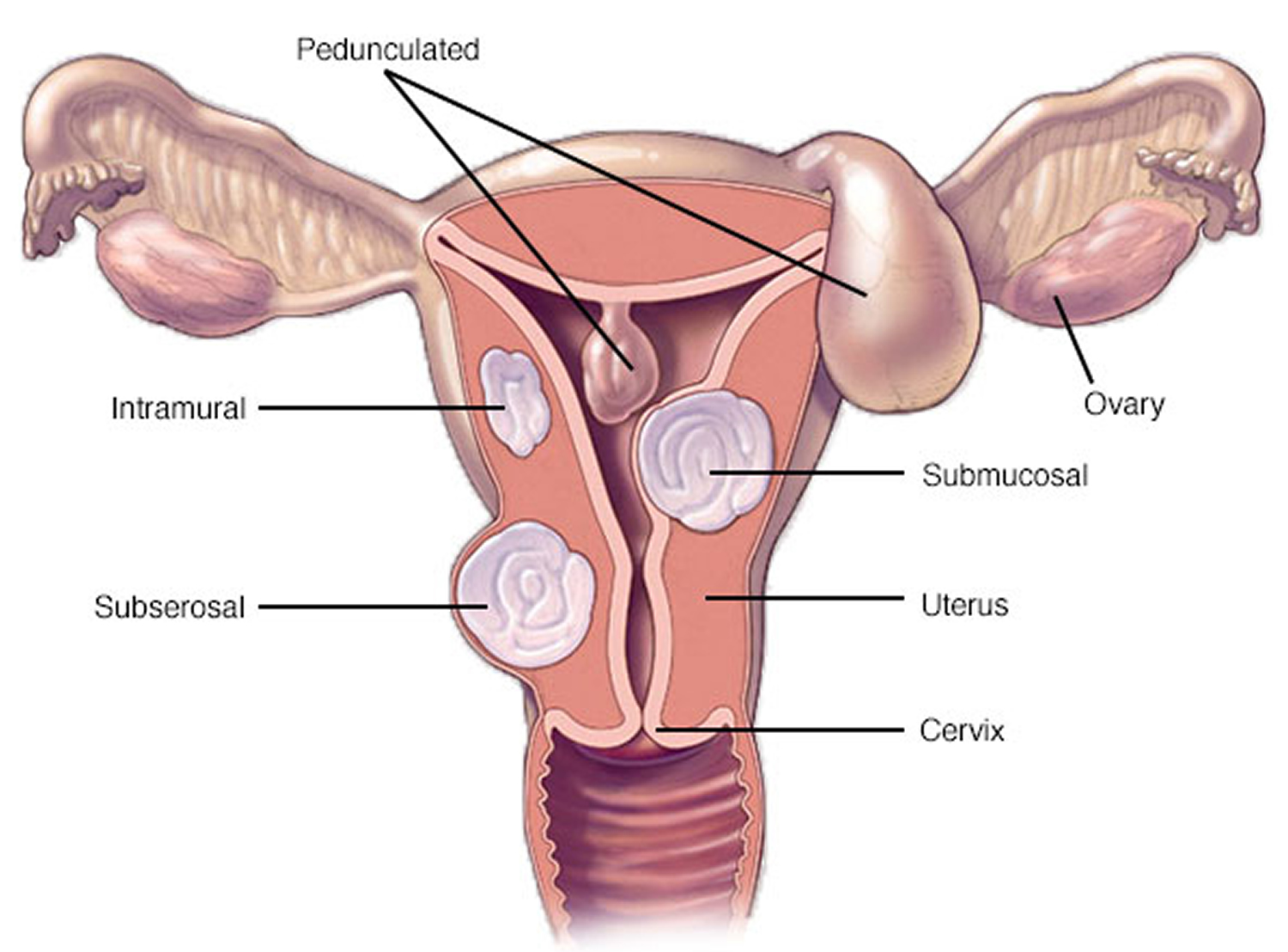 Uterine Fibroids Causes Symptoms Diagnosis Treatment Pregnancy