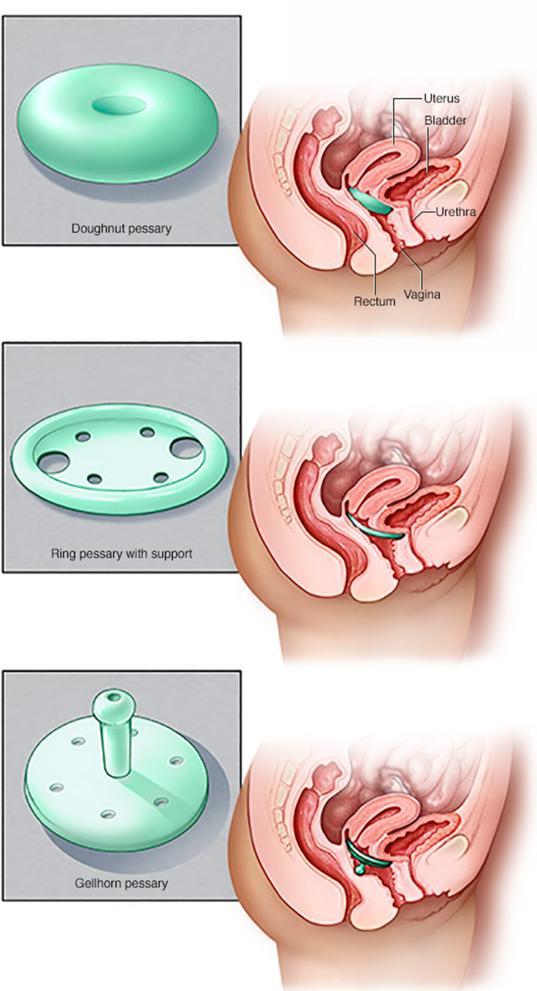 prolapsed-uterus-causes-signs-symptoms-treatment-and-exercises