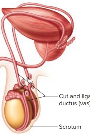 vasectomy