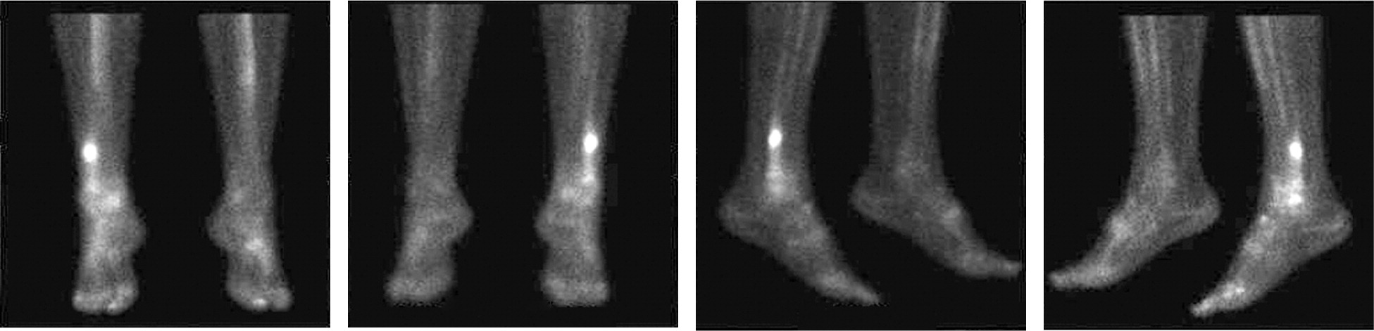 stress fracture shin from fall symptoms