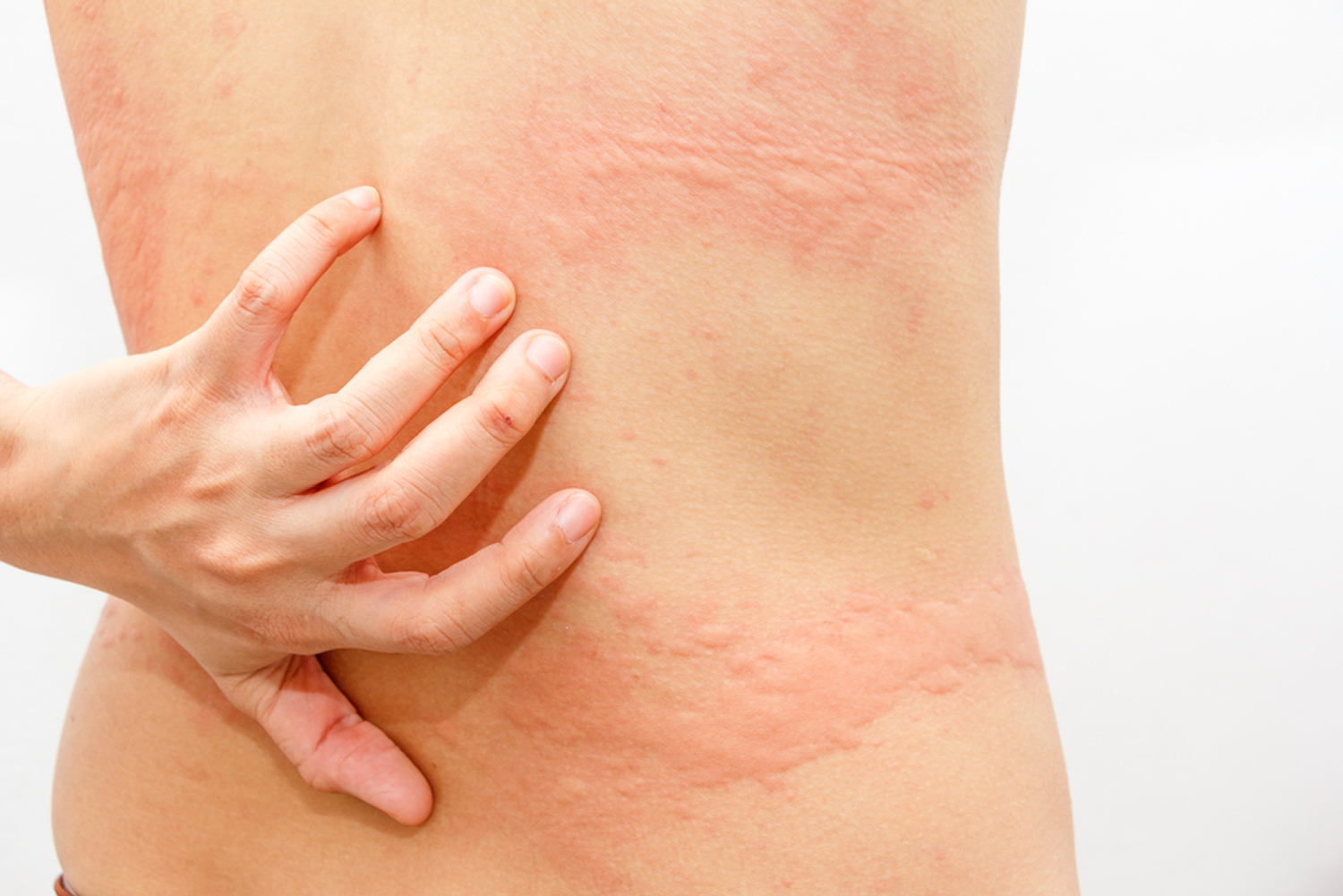 Aquagenic Urticaria - Strangest Diseases 