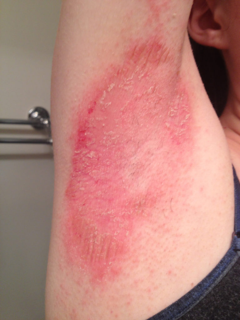 Armpit Rash - Itchy, Candida - Causes & Treatment