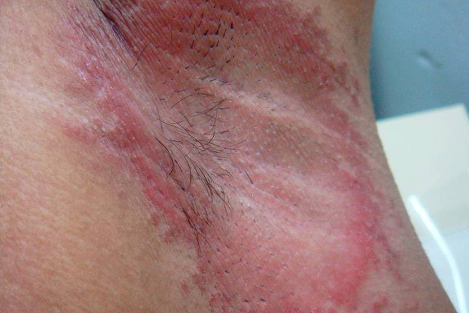 Armpit Rash - Itchy, Candida - Causes & Treatment