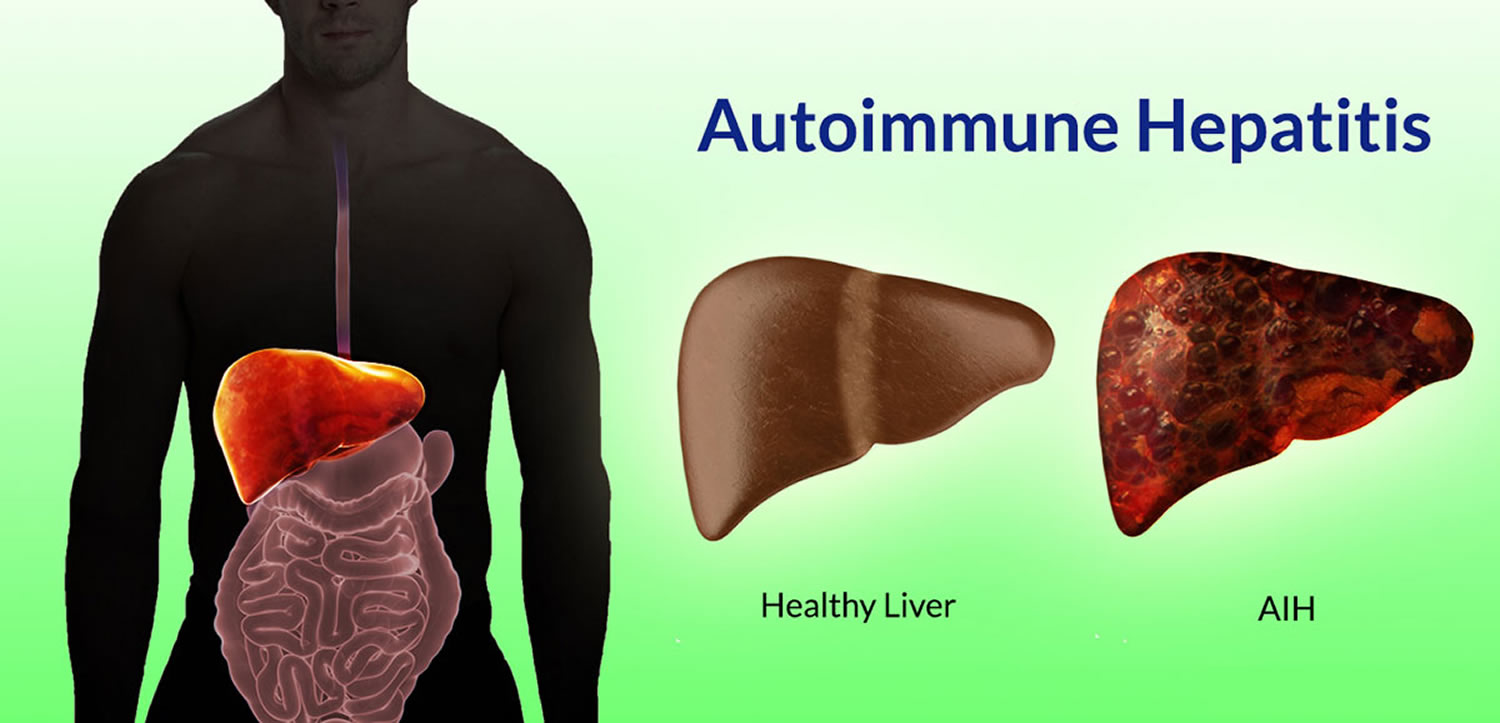 What Is Chronic Autoimmune Hepatitis