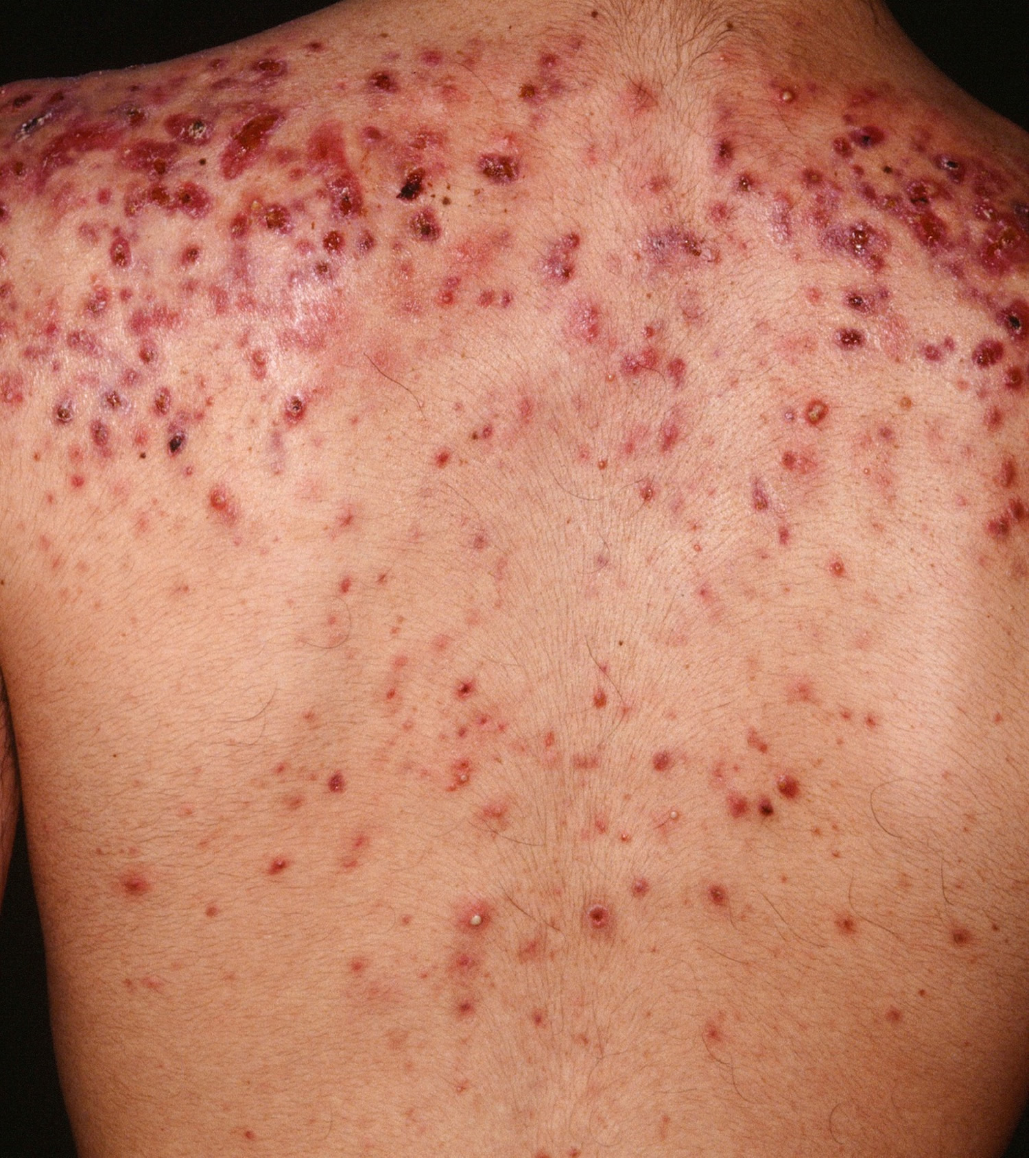 back-acne-causes-and-best-treatment-to-get-rid-of-back-acne-and-scars