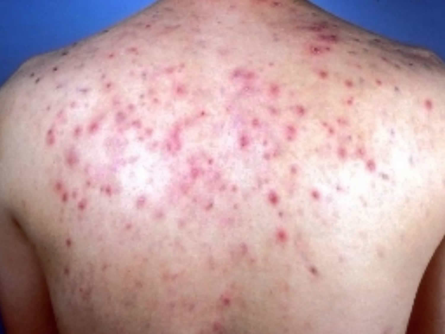 back-acne-causes-and-best-treatment-to-get-rid-of-back-acne-and-scars