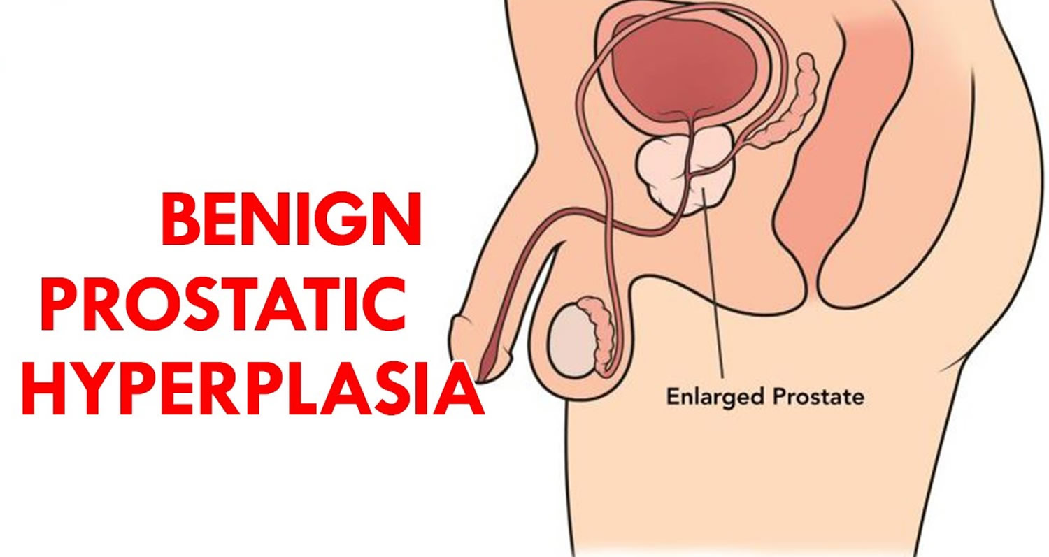 Benign Prostatic Hyperplasia (BPH): Symptoms & Treatment