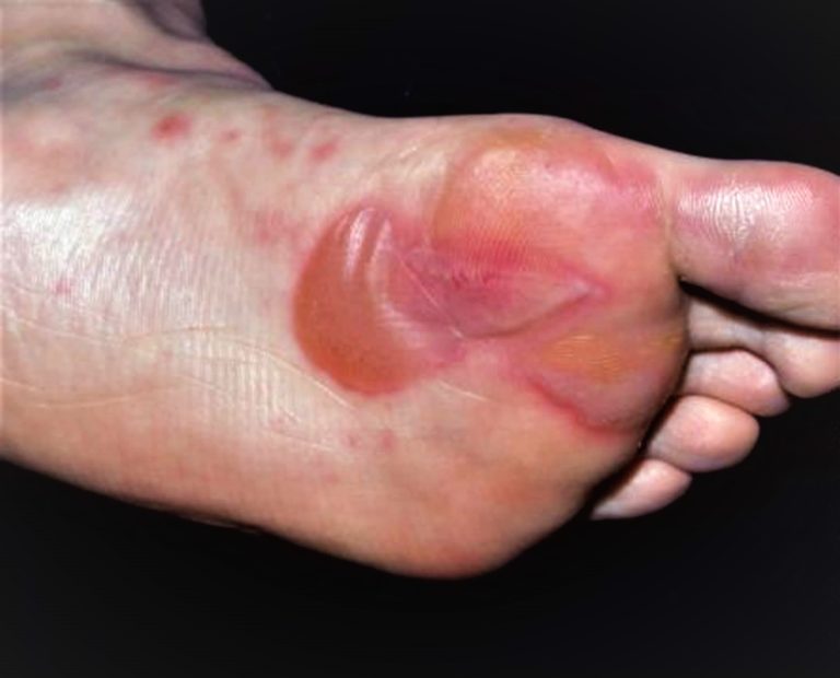 Blister on Foot Causes and How To Treat Foot Blisters