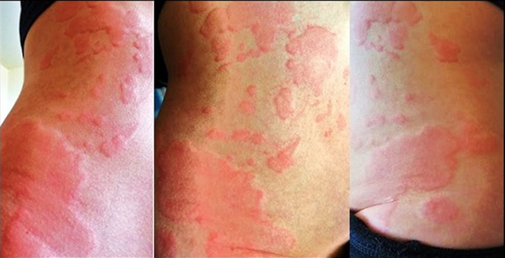 new research chronic urticaria