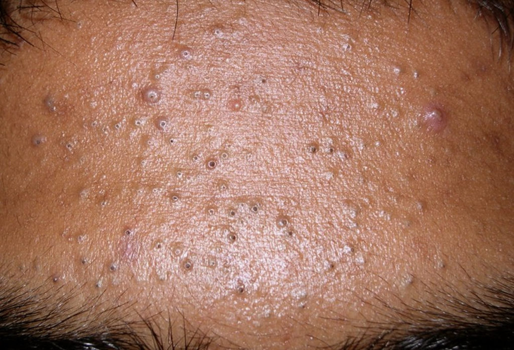 Blackheads - Causes, Treatment and How To Get Rid of Blackheads