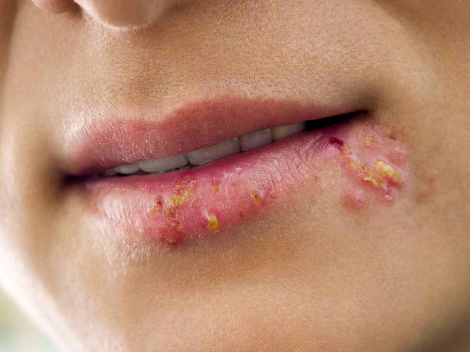 cold-sore-causes-treatment-prevention