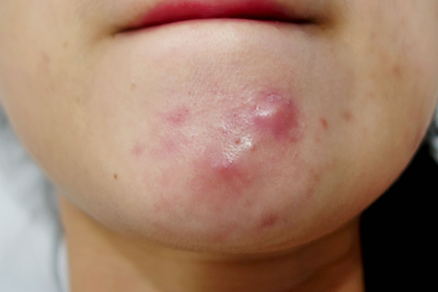 cystic-acne-causes-best-treatment-to-get-rid-of-cystic-acne-on-chin