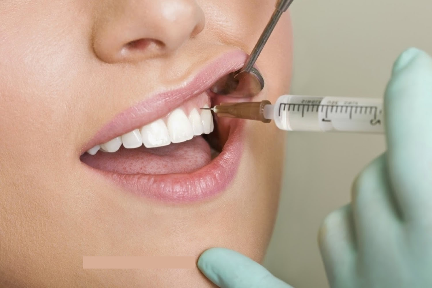 local-anesthesia-rexburg-eagle-rock-dental-care