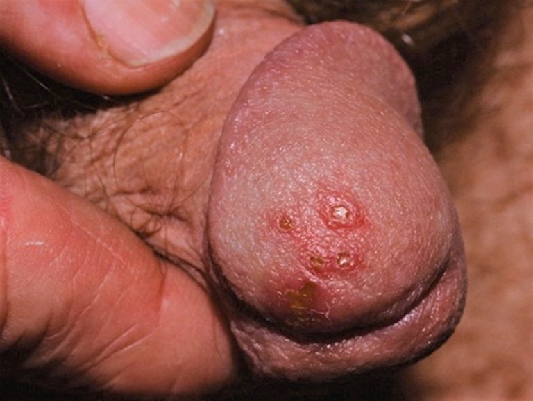 small-milia-bumps-on-penis-pictures