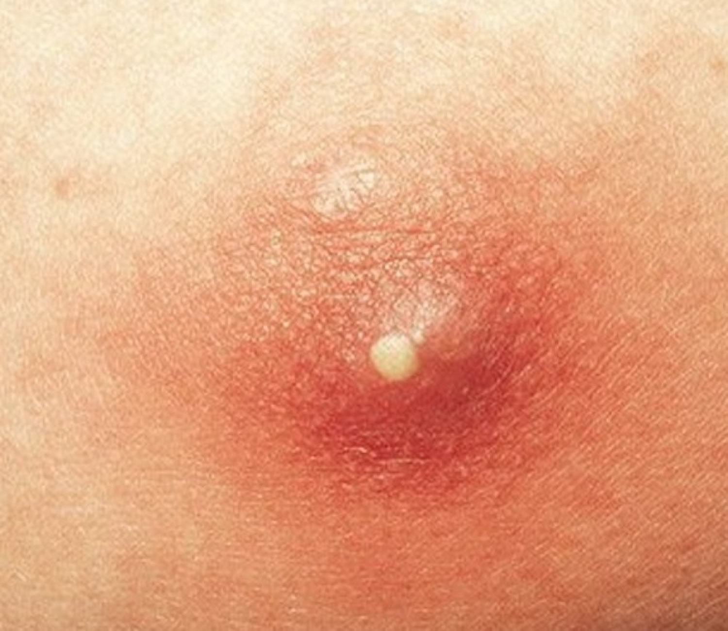 Pimples the of penis rid get to on What to