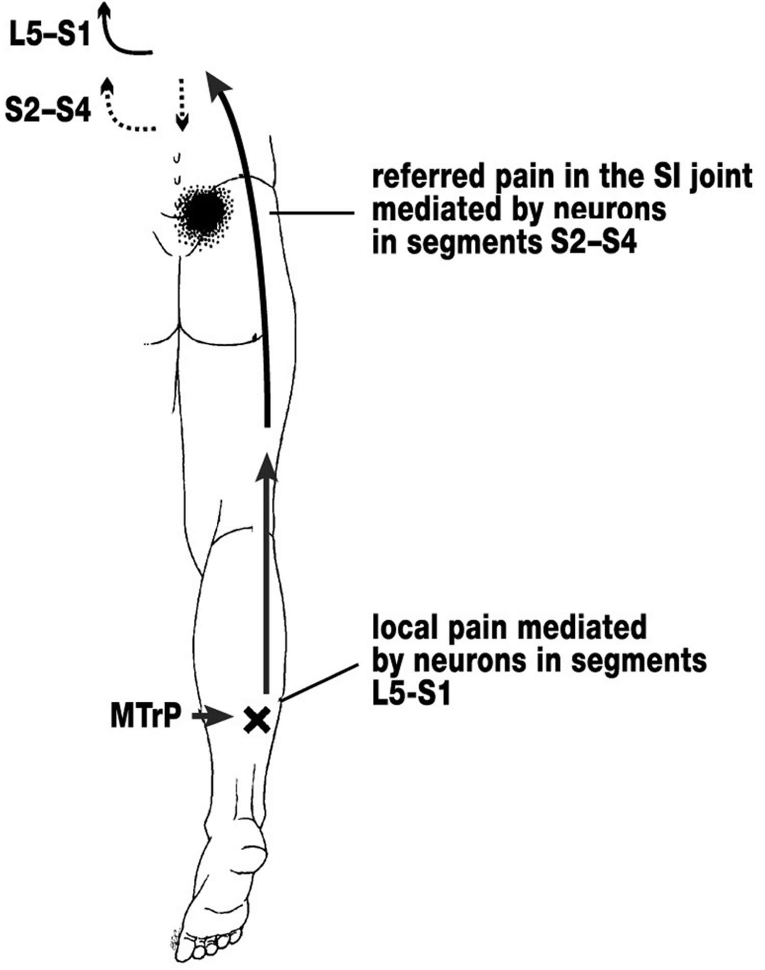 muscle-pain-causes-and-chronic-muscle-pain-treatment