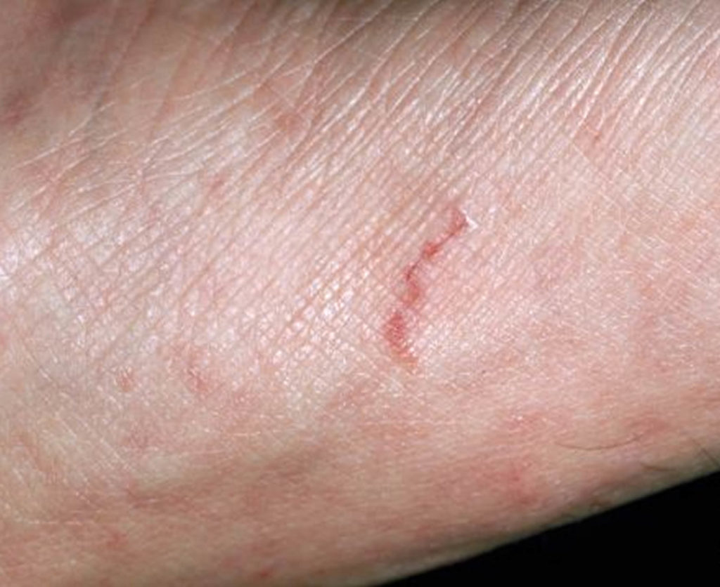 Can Scabies Not Spread at Betty Beasley blog