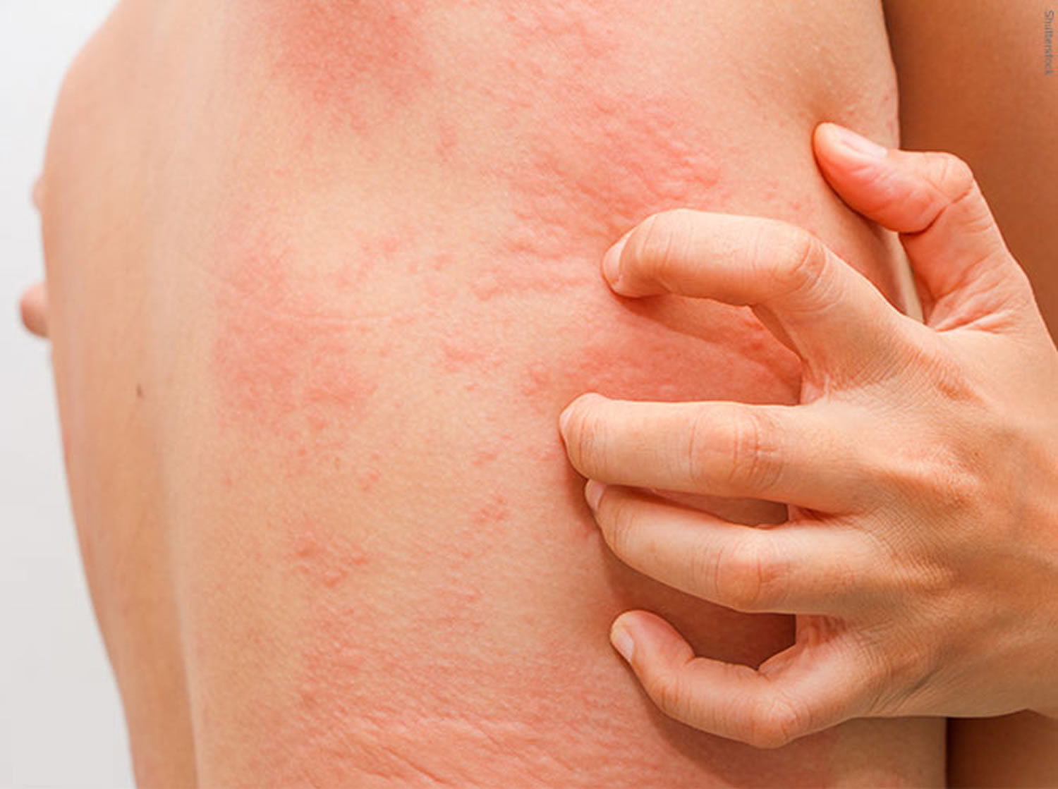 Can Urticaria Cause Miscarriage