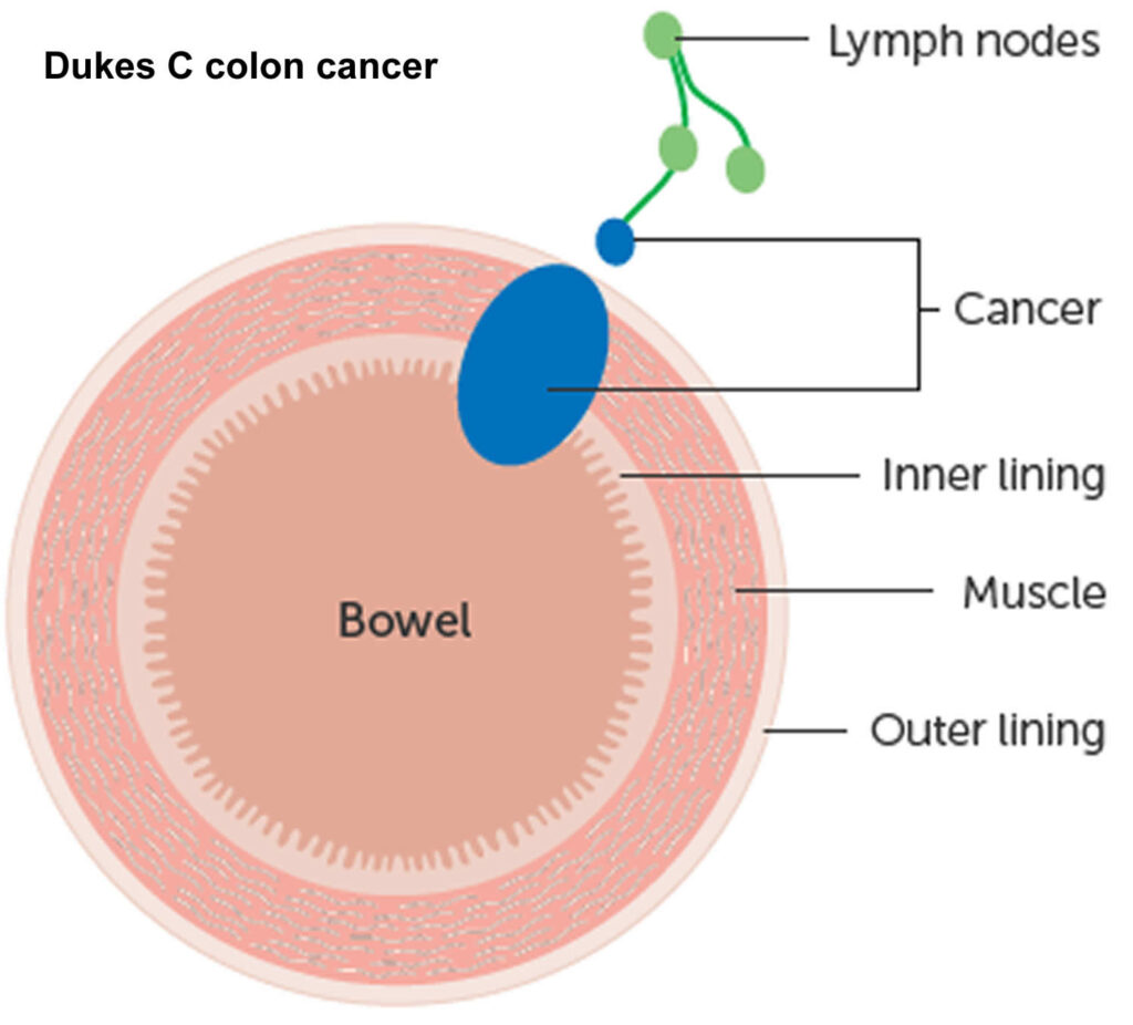 Colon Cancer Causes, Signs, Symptoms, Stages, Screening & Treatment