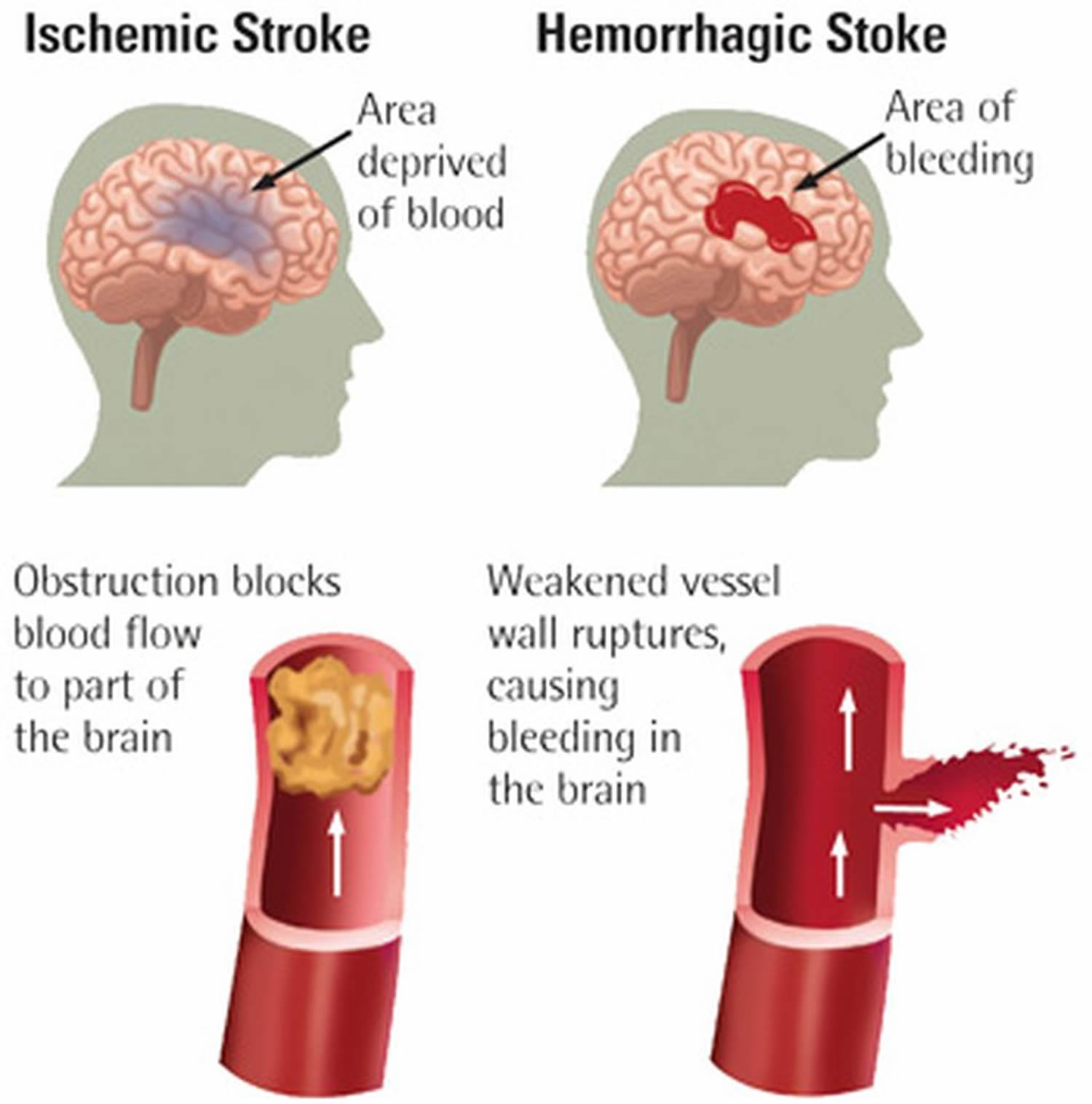 stroke affecting right side