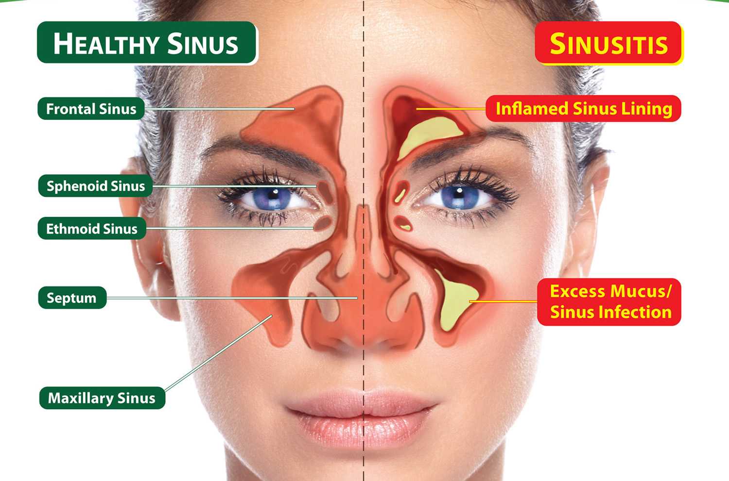 What Foods Help With Sinus Allergies