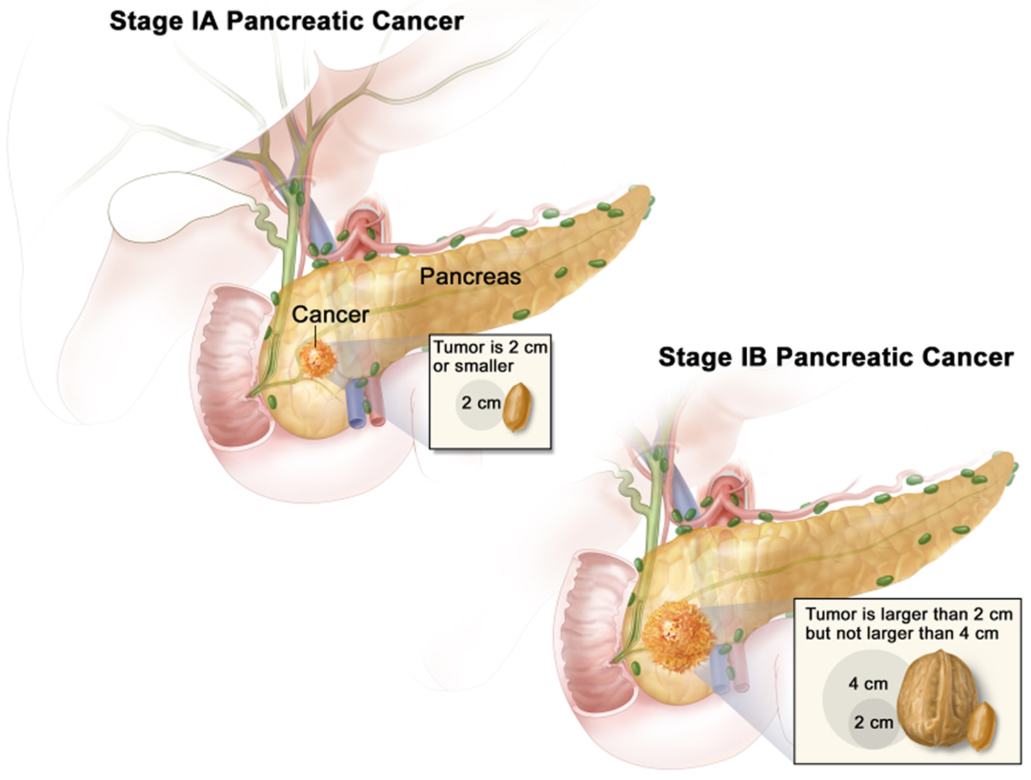 Stage 1 pancreatic cancer