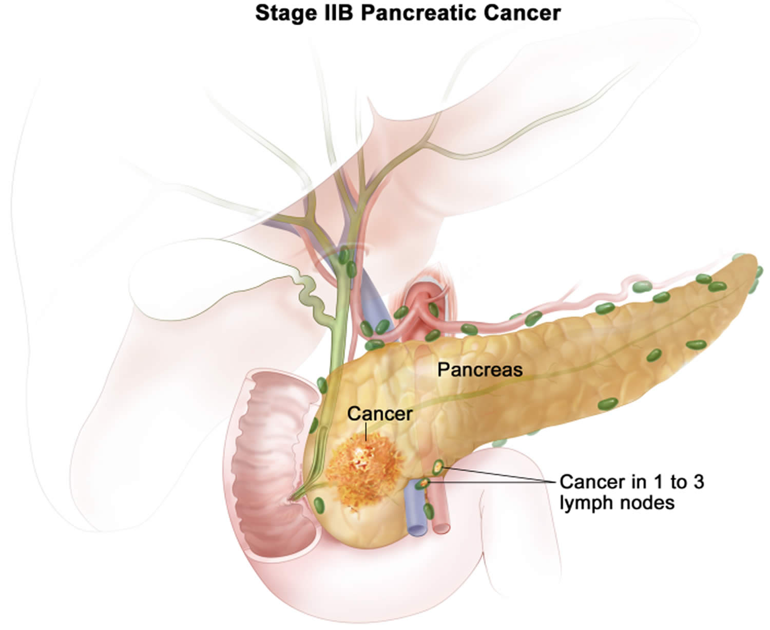 Stage 2B pancreatic cancer