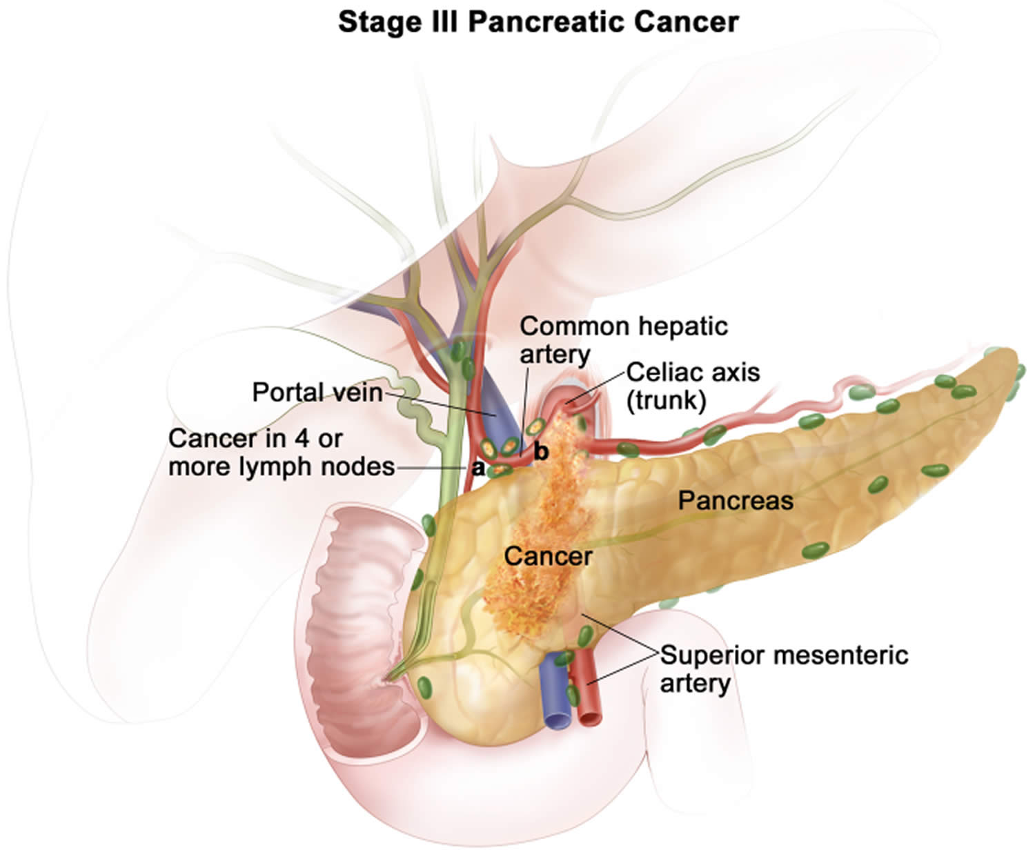 Stage 3 pancreatic cancer