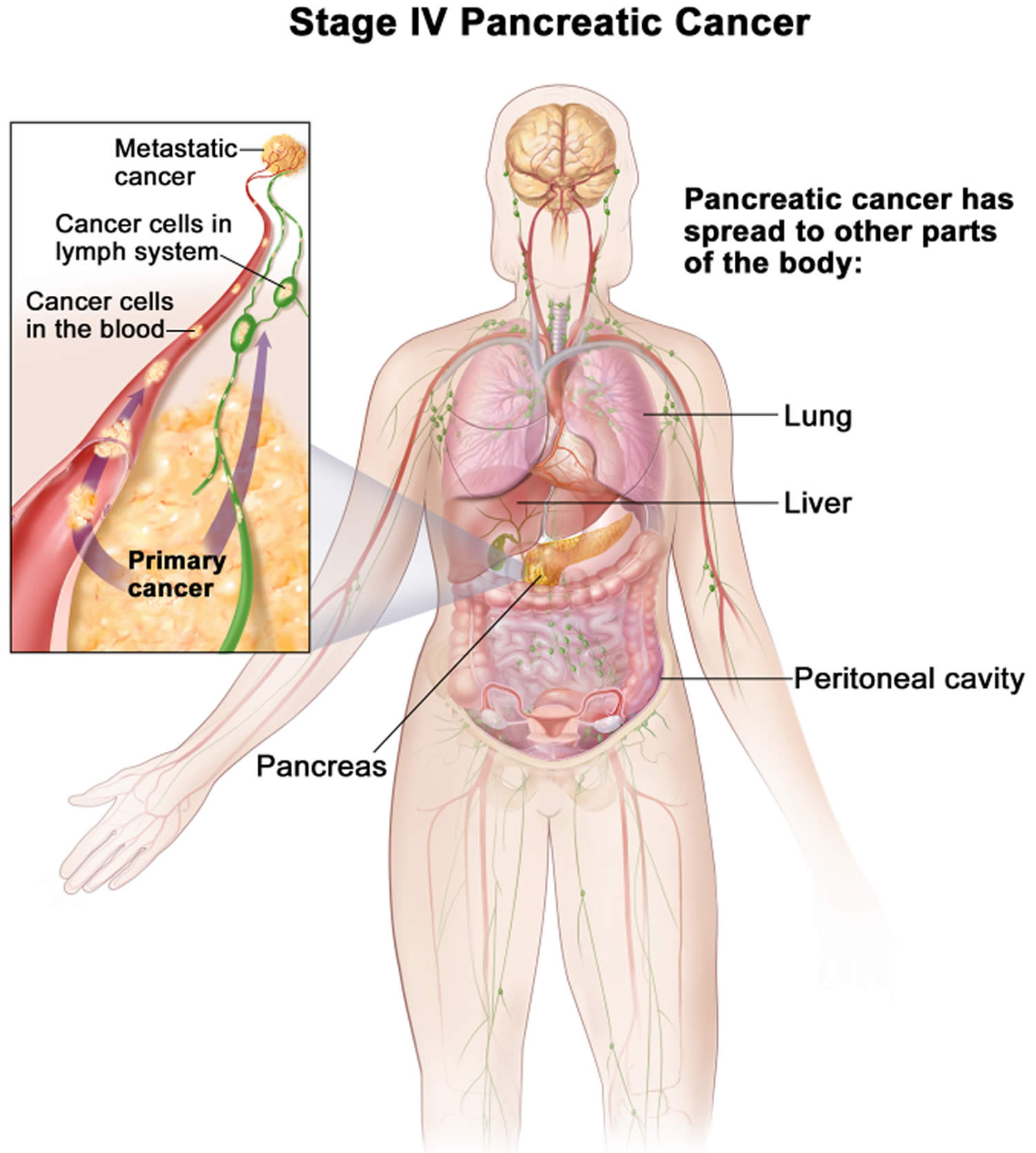 Stage 4 pancreatic cancer