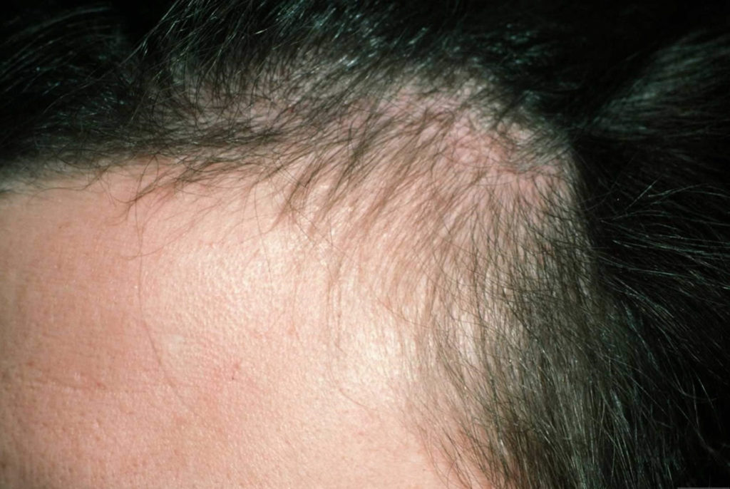 Hair Loss In Women & Men - Causes, Diagnosis & Hair Loss Treatment