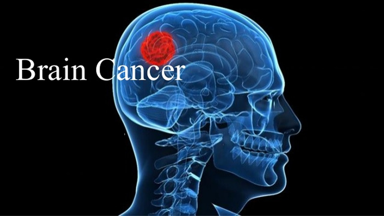 what causes brain cancer