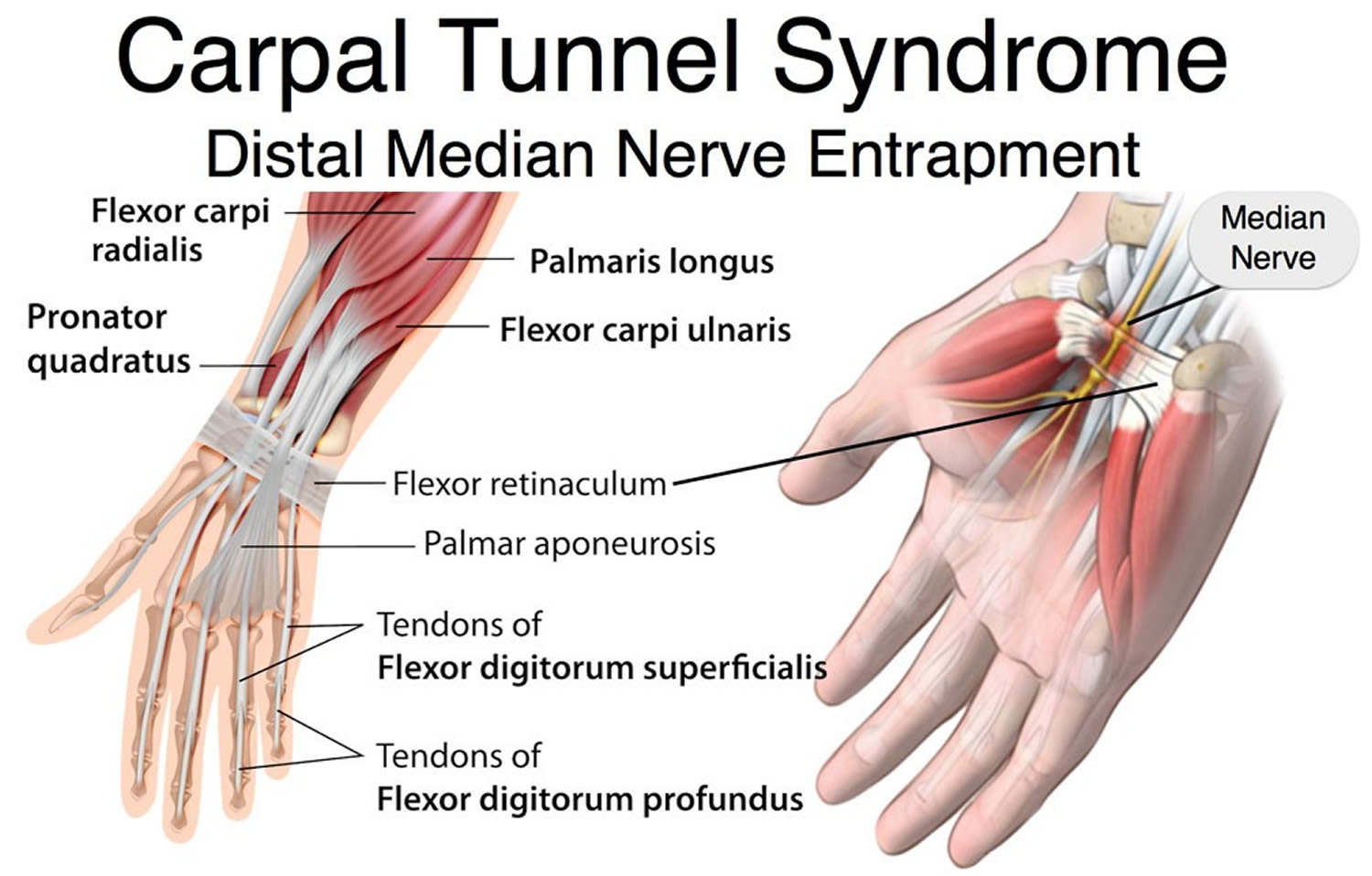 What Does Carpal Tunnel Syndrome Cause