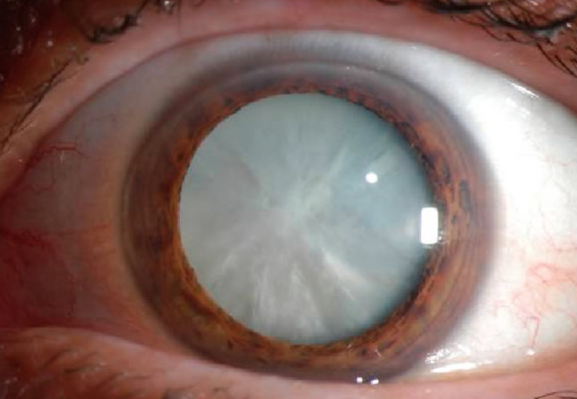 Cataracts Causes, Signs, Symptoms, Surgery, Recovery & Complications