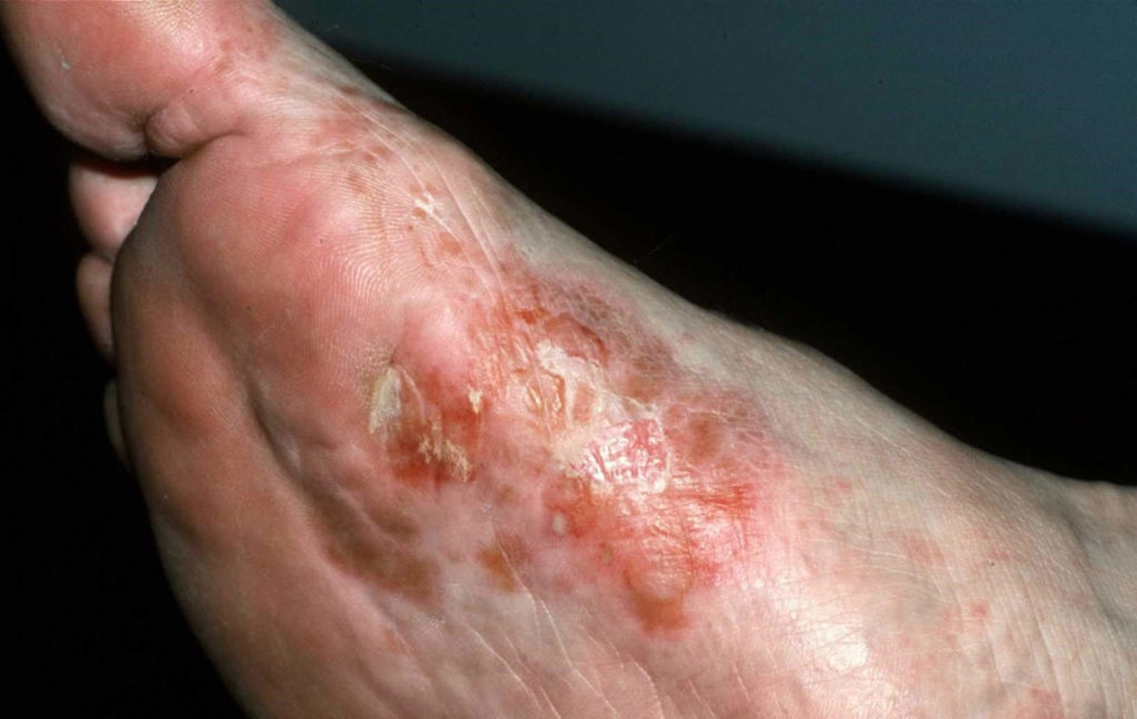 Eczema - Hand, Face, Baby, Causes, Symptoms & Treatment