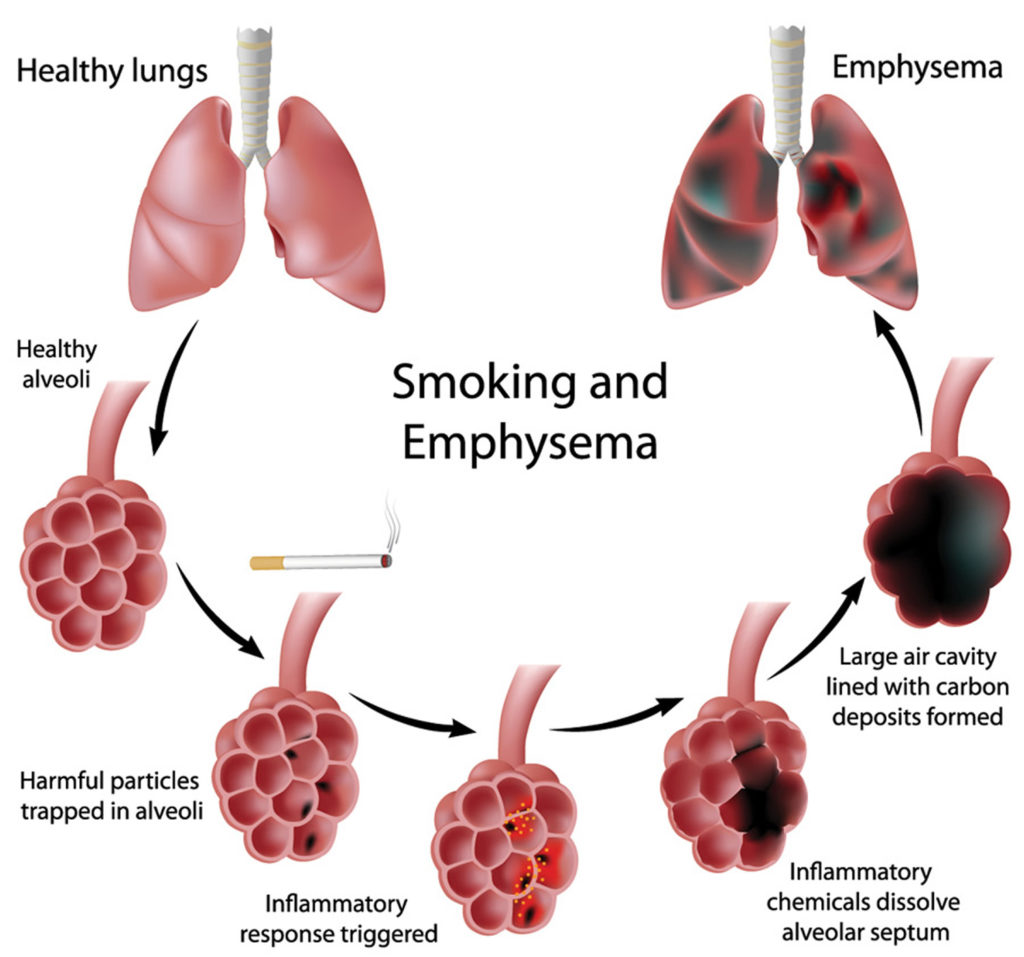 Emphysema 1 1024x957 