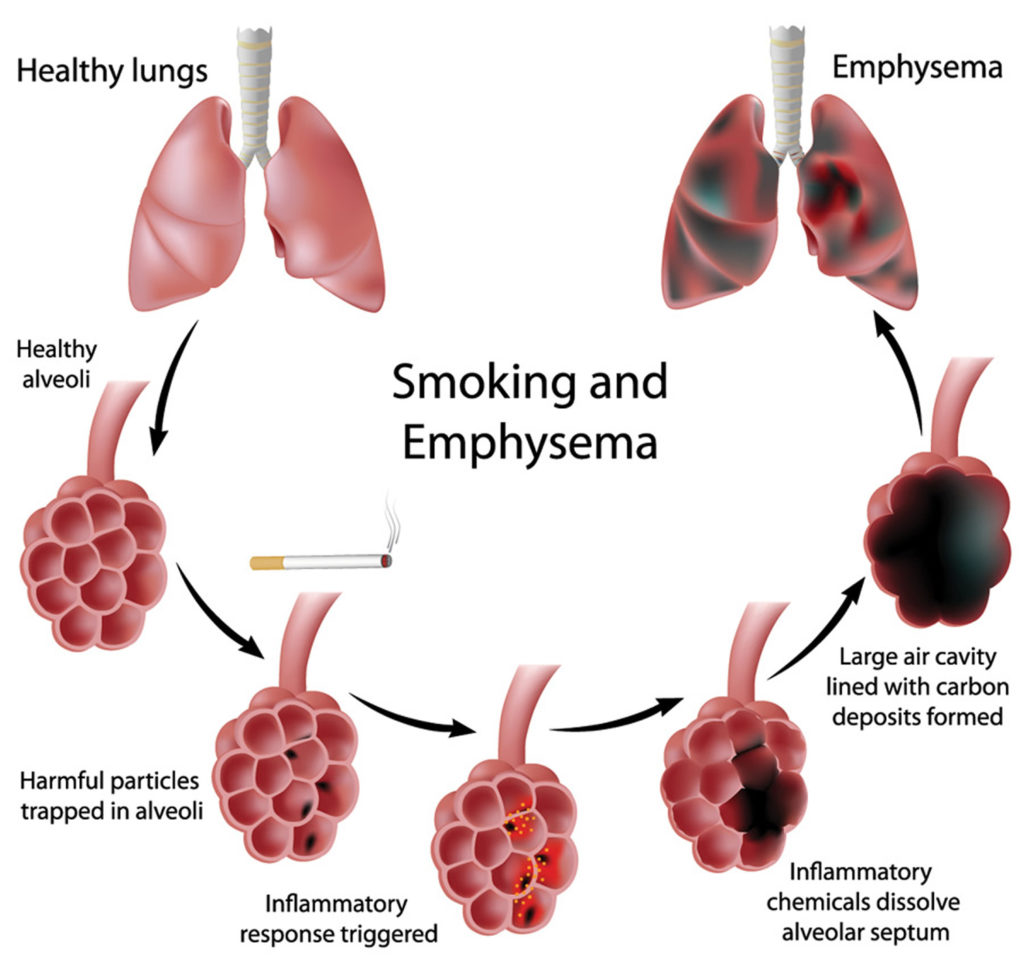 Understanding The 4 Stages Of Copd Copd Treatment Rem Vrogue co