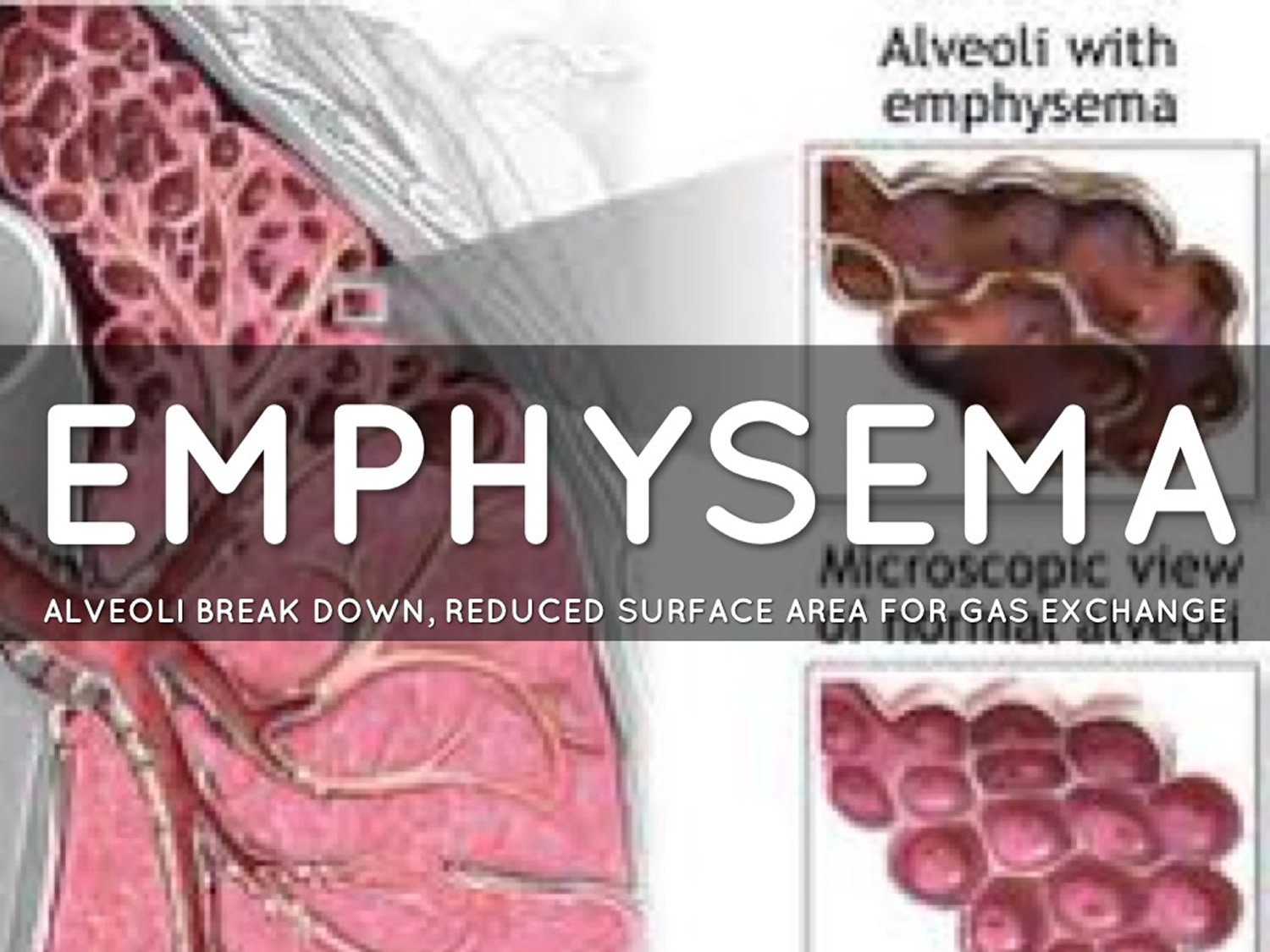 What Stage Is Severe Centrilobular Emphysema